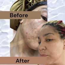 Load image into Gallery viewer, Her skin was attacked by acne since using coffee and honey soap it has cleared and softened immensely